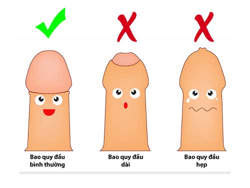 cắt bao quy đầu