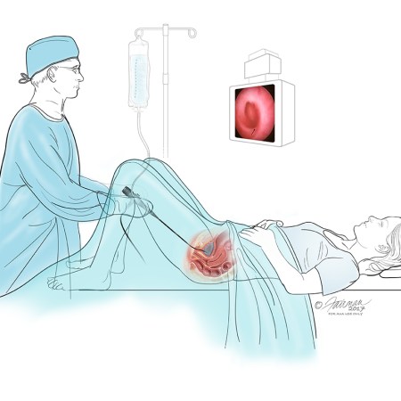 nội soi bàng quang