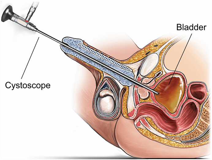 Kết quả hình ảnh cho cystoscopy
