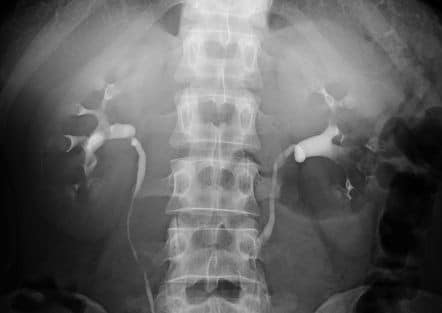 Medullary Sponge Kidney